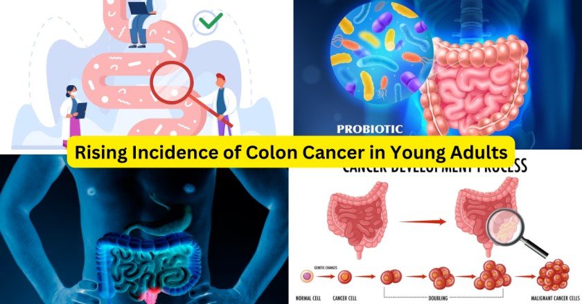 Rising Incidence of Colon Cancer in Young Adults-wildadda.com
